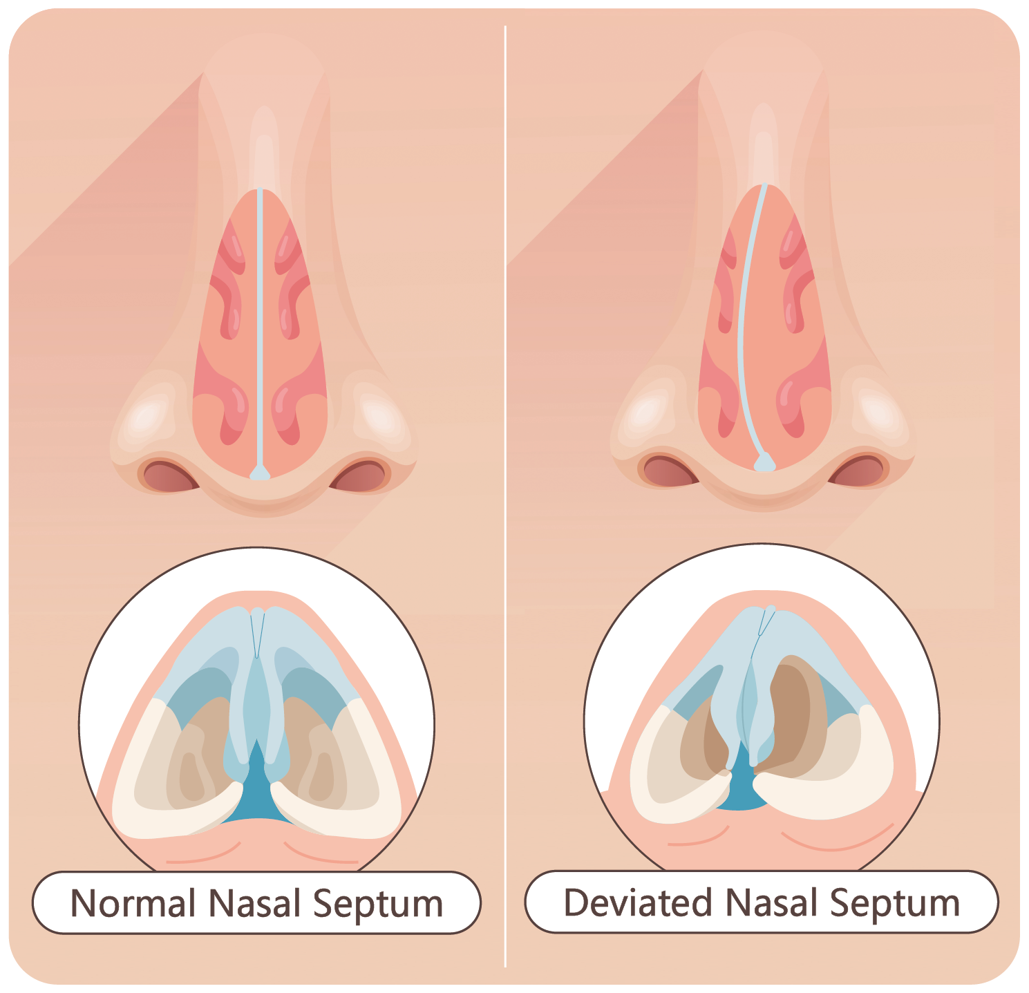 Why do I often have stuffy nose nasal congestion when lying down How to solve the problem Centres and Services St. Paul s Hospital